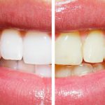 Teeth Whitening