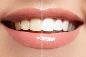 Popular cosmetic dentistry procedure - teeth whitening