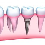 dental implants