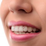 Invisalign Clean Aligners