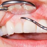 Gum Disease Prevention Tips