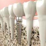 How Long Do Dental Implants Last