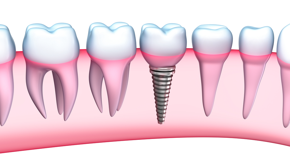 The Different Parts Of A Dental Implant